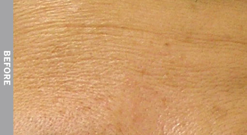 Treatment for fine lines and wrinkles in Belton and Killeen, TX
