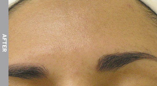 Treatment for hyperpigmentation in Killeen and Belton, TX
